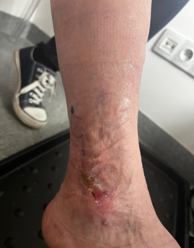 Ozonoterapia w gojeniu ran PO