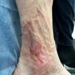 Ozonoterapia w gojeniu ran PRZED
